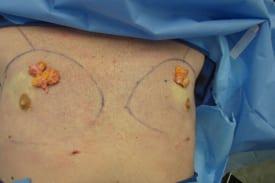 Gynecomastia Surgery Before & After Image