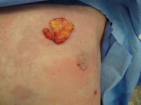 Gynecomastia Surgery Before & After Image