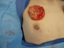 Gynecomastia Surgery Before & After Image