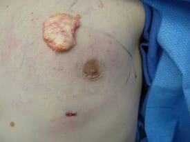 Gynecomastia Surgery Before & After Image