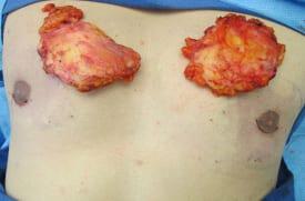 Gynecomastia Surgery Before & After Image