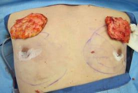 Gynecomastia Surgery Before & After Image