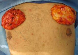 Gynecomastia Surgery Before & After Image