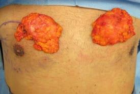 Gynecomastia Surgery Before & After Image