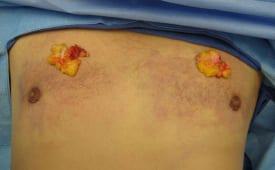 Gynecomastia Surgery Before & After Image