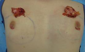 Gynecomastia Surgery Before & After Image