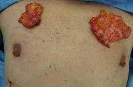 Gynecomastia Surgery Before & After Image