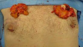 Gynecomastia Surgery Before & After Image