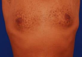 Gynecomastia Surgery Before & After Image