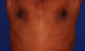 Gynecomastia Surgery Before & After Image