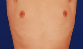 Gynecomastia Surgery Before & After Image