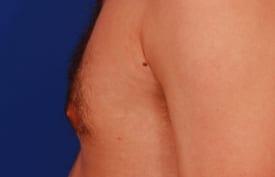 Gynecomastia Surgery Before & After Image