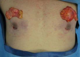 Gynecomastia Surgery Before & After Image