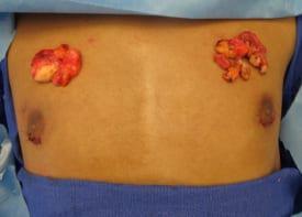 Gynecomastia Surgery Before & After Image