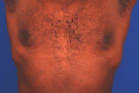 Gynecomastia Surgery Before & After Image