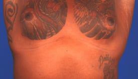 Gynecomastia Surgery Before & After Image