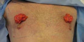 Gynecomastia Surgery Before & After Image