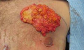 Gynecomastia Surgery Before & After Image