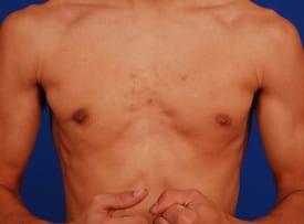 Gynecomastia Surgery Before & After Image