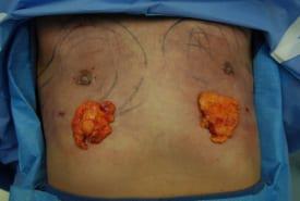 Gynecomastia Surgery Before & After Image