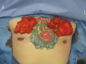 Gynecomastia Surgery Before & After Image