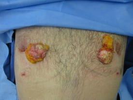 Gynecomastia Surgery Before & After Image