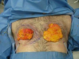 Gynecomastia Surgery Before & After Image