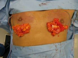 Gynecomastia Surgery Before & After Image