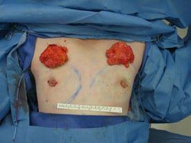 Gynecomastia Surgery Before & After Image