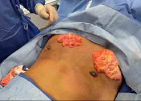 Revision Gynecomastia Surgery Before & After Image