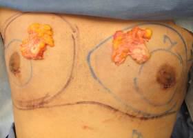 Revision Gynecomastia Surgery Before & After Image