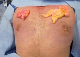 Revision Gynecomastia Surgery Before & After Image