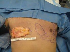 Revision Gynecomastia Surgery Before & After Image