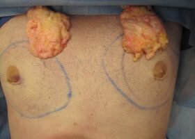 Glands removed during Austin Gynecomastia surgery