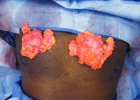 Gynecomastia Surgery Before & After Image