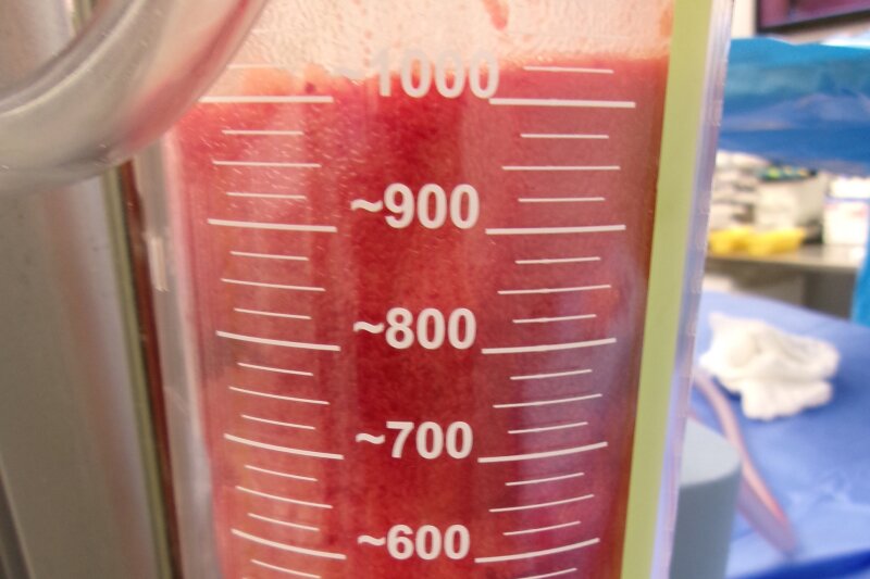 Gynecomastia Surgery Before & After Image