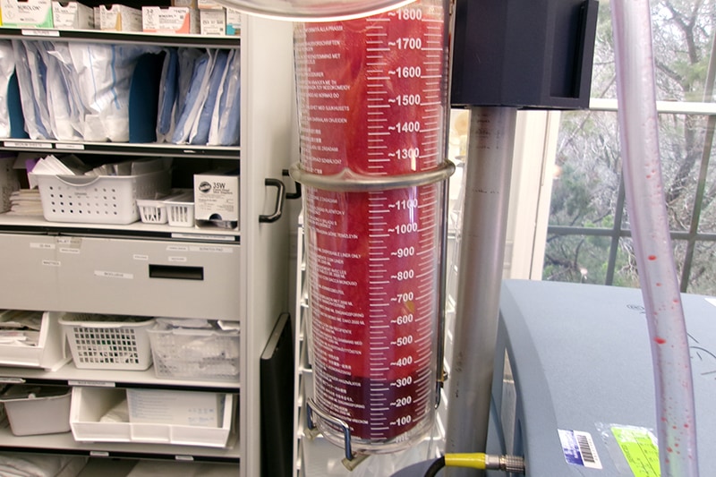 Gynecomastia Surgery Before & After Image