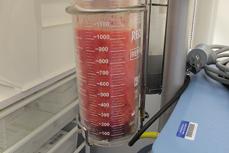 Gynecomastia Surgery Before & After Image