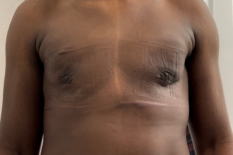 Gynecomastia Surgery Before & After Image