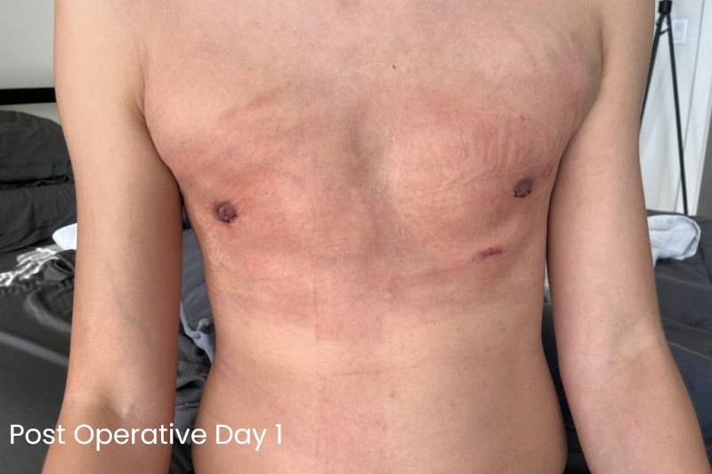 Gynecomastia Surgery Before & After Image