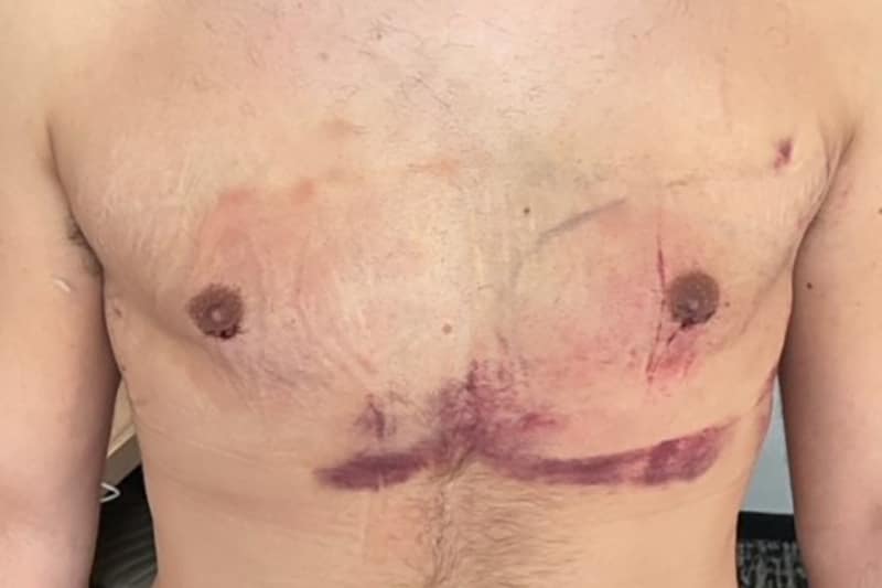 Gynecomastia Surgery Before & After Image