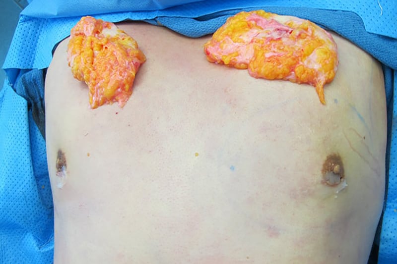 Gynecomastia Surgery Before & After Image