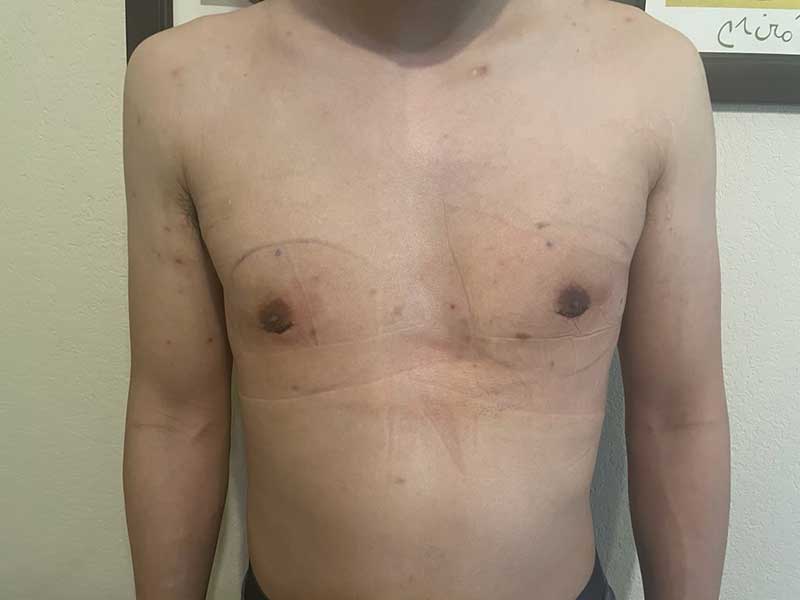 Gynecomastia Surgery Before & After Image