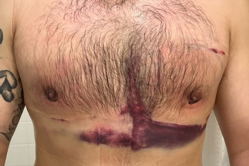 Gynecomastia Surgery Before & After Image