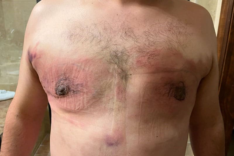 Gynecomastia Surgery Before & After Image