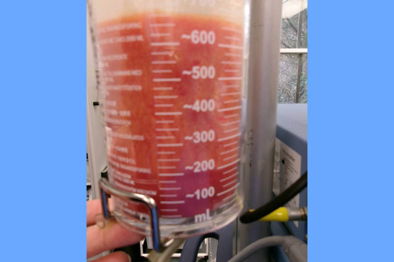 Gynecomastia Surgery Before & After Image