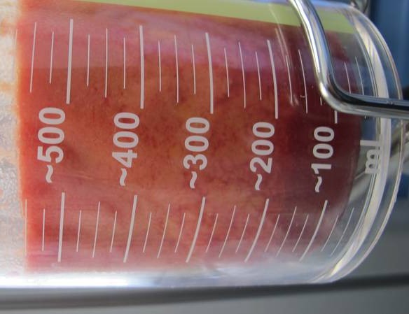 Gynecomastia Surgery Before & After Image