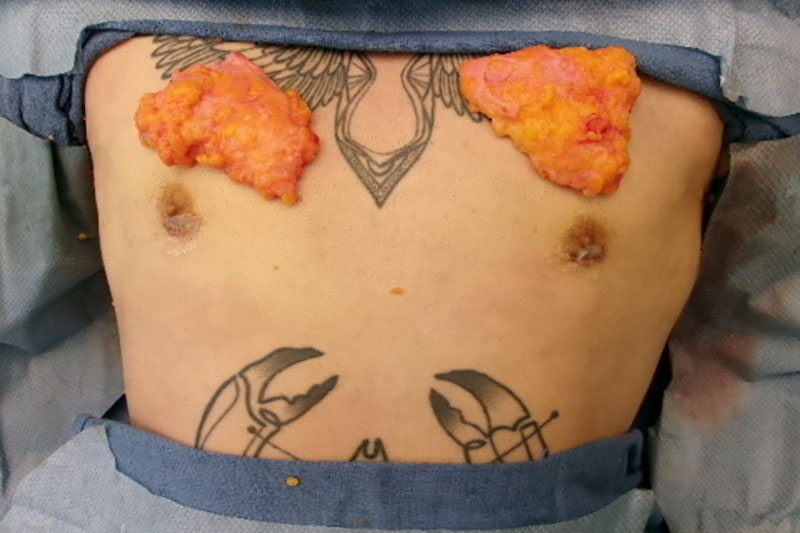 Gynecomastia Surgery Before & After Image