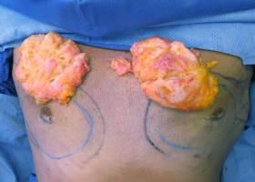 Gynecomastia Surgery Before & After Image