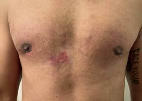 Gynecomastia Surgery Before & After Image